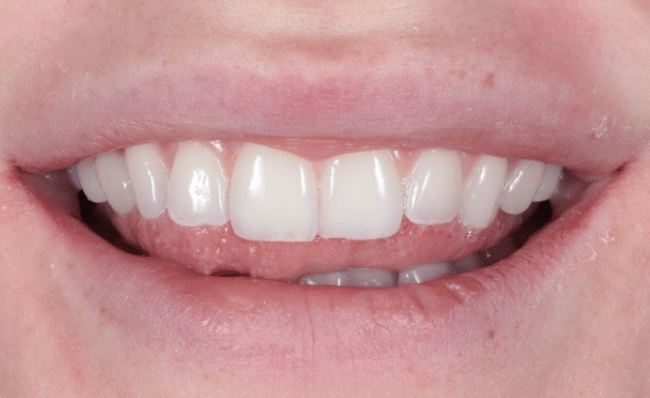 Composite bonding results