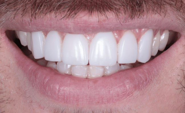 After dental implant